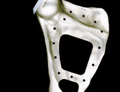 Prosthetic Design