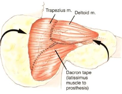 Soft Tissue Coverage 
