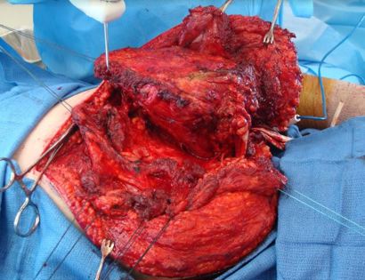 Intra-Op: Scapula Released from Chest Wall