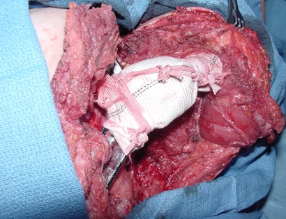 Intra-Op: Ligaments Restored