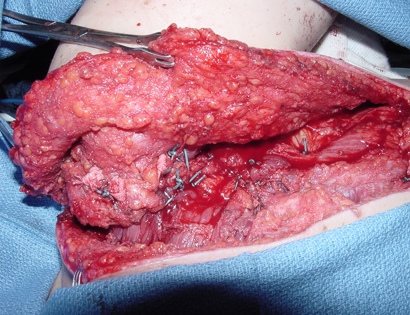 Intra-Op: Soft Tissue Coverage