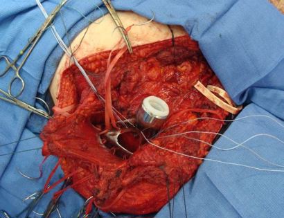 Intra-Op: Scapula Prosthesis Inserted