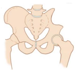 Pelvic Tumor Removal