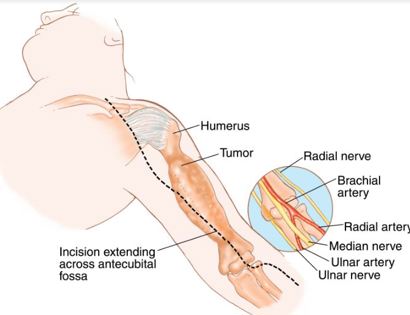 Tumor Removal and Reconstruction 
