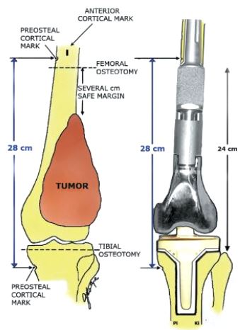 Distal Femur Prosthesisss
