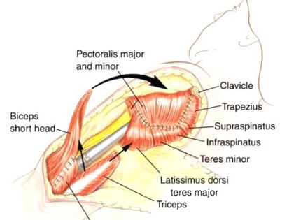 Soft Tissue Coverage 
