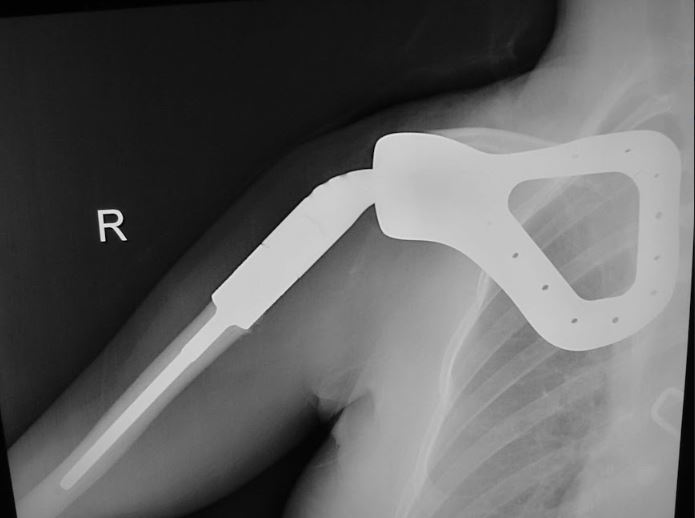 Scapula Xr 2