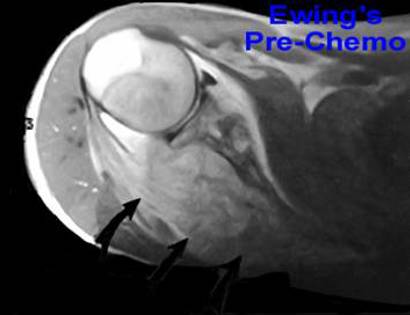 MRI of Scapula Tumor 