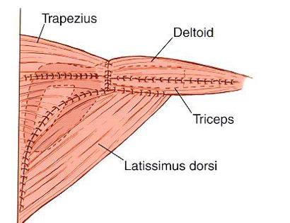 Entire Prosthesis Covered 