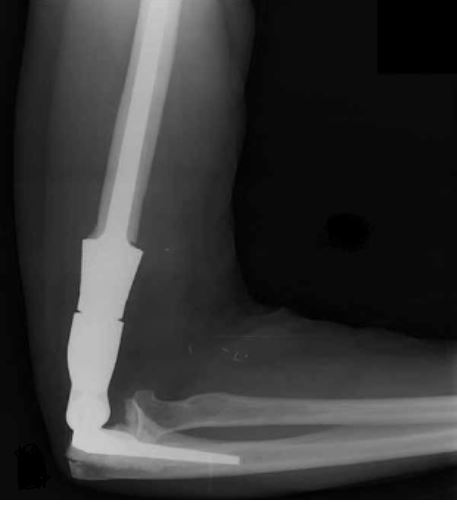 Distal Humerus Xr
