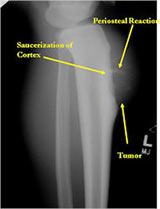 Periosteal Osteosarcoma