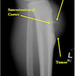 Periosteal Osteosarcoma