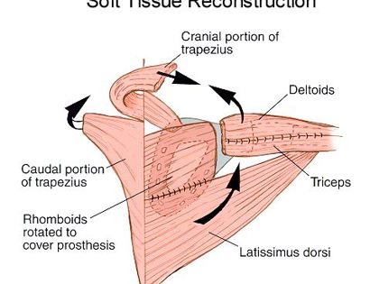 Total Scapula Soft Tissue Reconstruction 