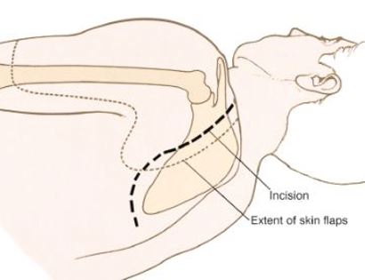 Posterior Incision 