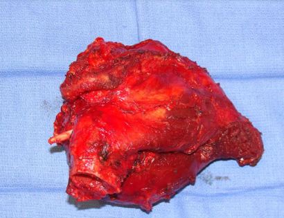 Intra-Op: Specimen Photo