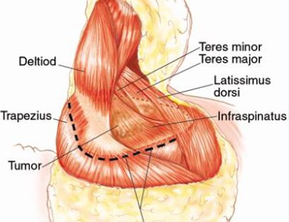 Muscle Release and Dissection of Nerves and Vessels