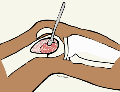 Intralesional Curettage 