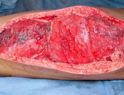 Intra-Op: Soft Tissue Coverage 