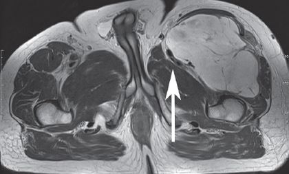 Quadriceps Mri
